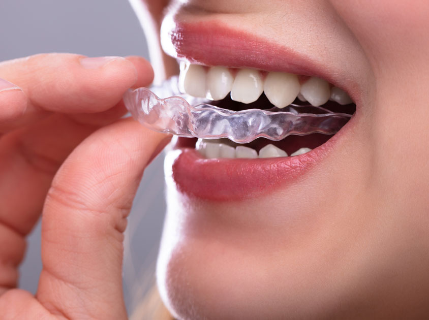 Braces