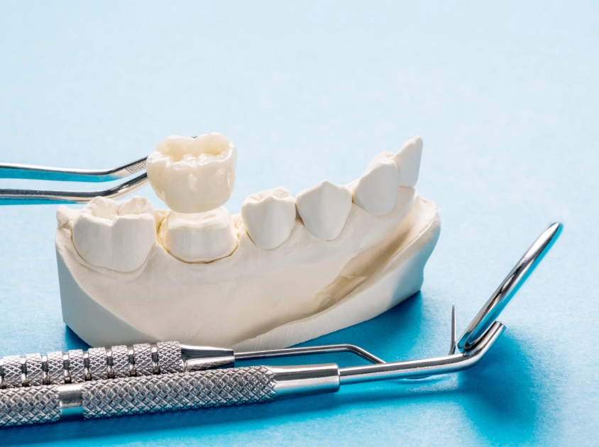 Cheap Dental Crowns