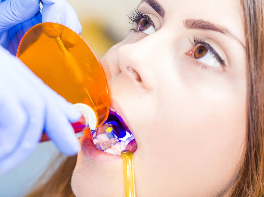 Cosmetic Bonding