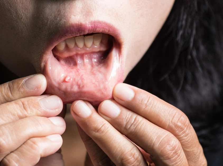 Oral Cancer Screening