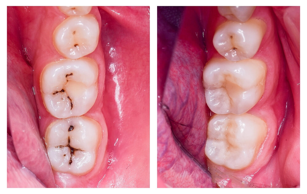 Tooth Colored Fillings
