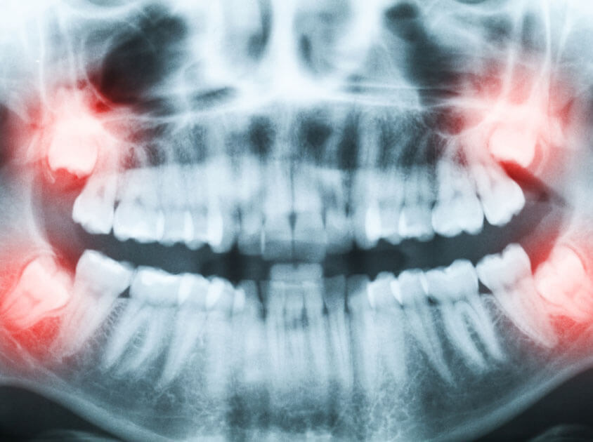 Wisdom Tooth Extractions